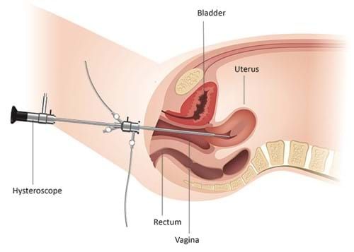 Hysteroscopy