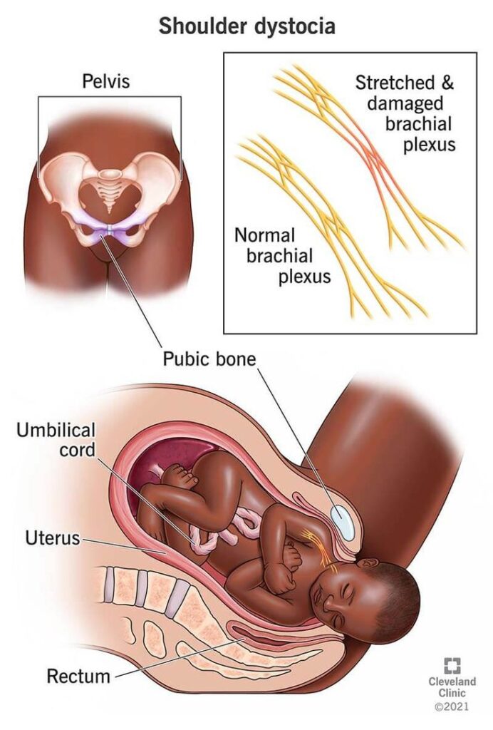 Shoulder Dystocia