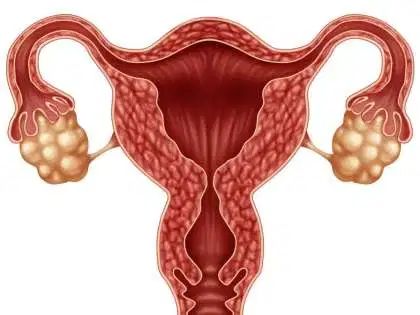 Vaginal hysterectomy