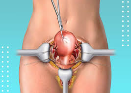 abdominal hysterectomy